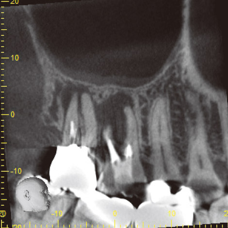 図17 CBCT近遠心断面像。