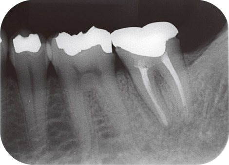 図2 39歳男性。下顎左側第二大臼歯。