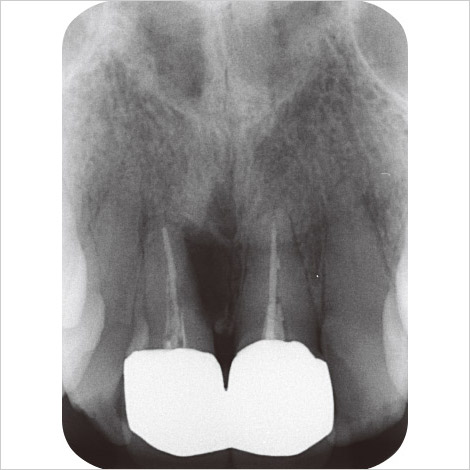 図3 57歳女性。上顎右側中切歯のデンタルX線写真。