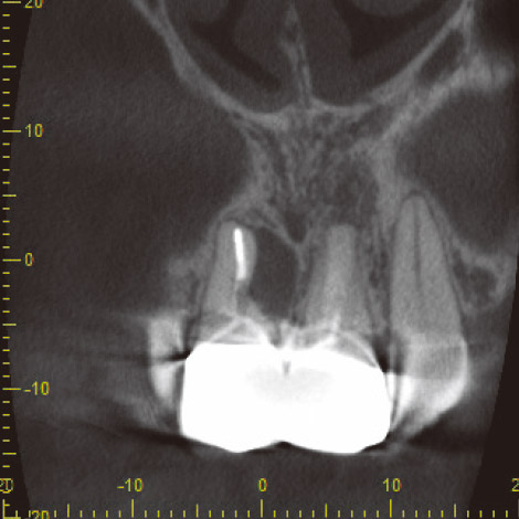 図4 CBCT像。