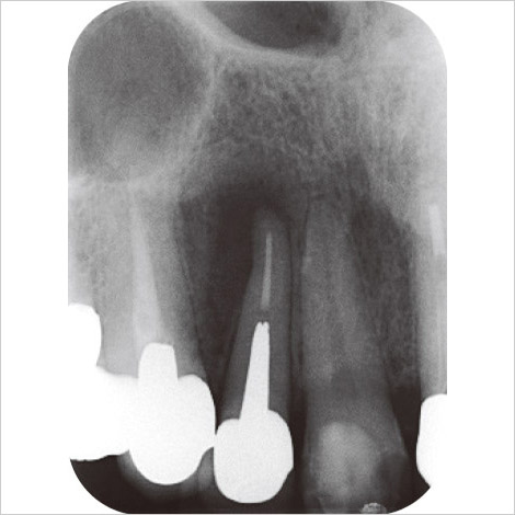 図5 54歳男性。上顎右側側切歯。