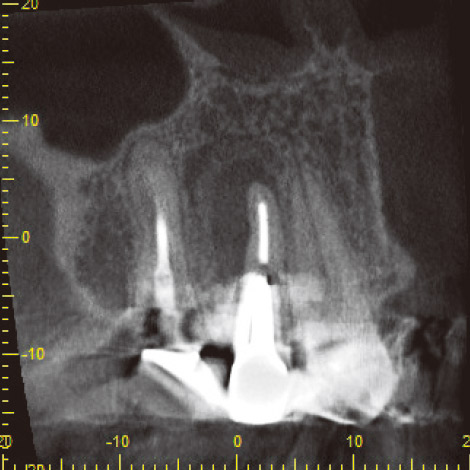 図6 CBCT近遠心断面像。