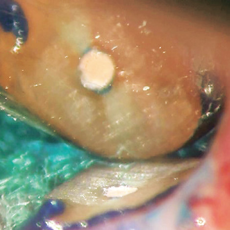 図8 歯根端切除後の切断面。歯科用顕微鏡下での強拡大像。