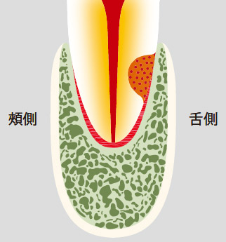 図20-a 歯根外部吸収。