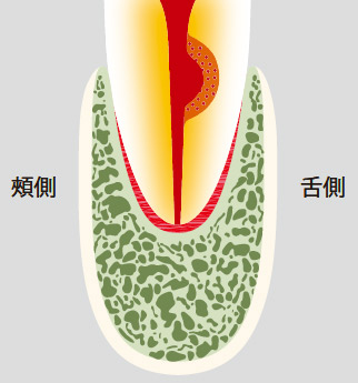 図20-b 歯根内部吸収。
