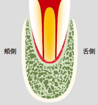 図20-c 単根2根管ではお互いに重複して1根管に見える。