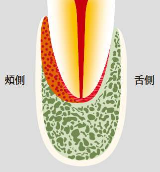 図21-a 頰側や舌側に沿った根側病変はデンタルX線写真には写らない。