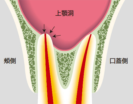 図21-b 上顎大臼歯の根尖が上顎洞に接しているとそこに病変があってもデンタルX線写真では不鮮明になりやすい。
