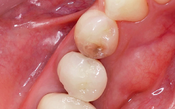 図1 左側第一小臼歯部の冷水痛、違和感を主訴に来院。