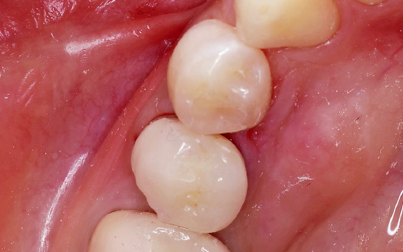 図12 咬合調整、最終研磨後の口腔内の状態