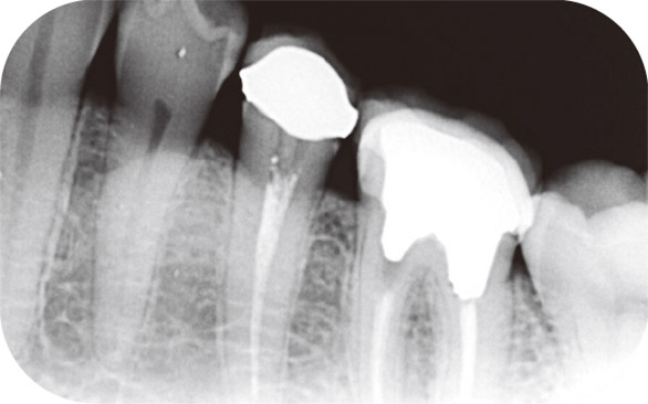 図2 術前のX線写真。遠心隣接面コンタクト部にカリエスを認める。象牙質及び歯髄への石灰化が観察される。