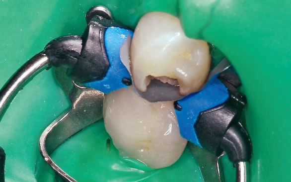 図7 隣接面コンタクトの回復のためにコンポジタイト3Dリテーナー（スモール）を使用。残存歯質との適合を確認する。