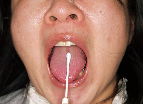 写真6 舌背部からの細菌採取