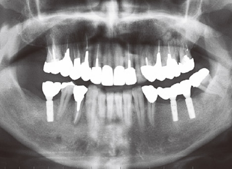 写真12 症例A：オルソパントモX線所見