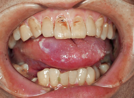 写真13 舌口底癌：放射線治療後