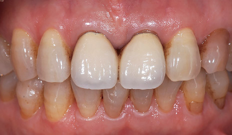 図1-1 初診。上顎左右中切歯の不良補綴装置による審美障害をフルジルコニアクラウン（カタナジルコニアUTML）で改善することとした。
