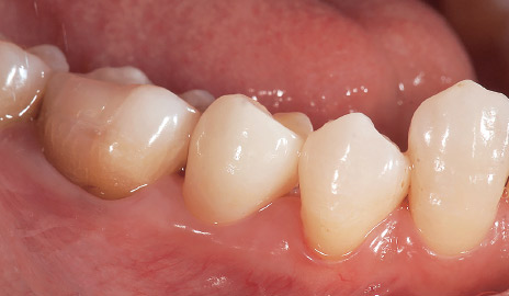 図2-5 ステイン、グレーズ焼成を施したSTMLクラウンは透明感や表面性状が周囲の天然歯に調和している。