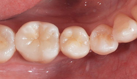 図2-6 咬合面観。カタナジルコニアSTMLを用いれば、審美性の高い臼歯のフルジルコニア修復が可能である。
