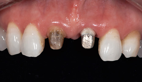 図1-2 支台歯形成。11は有髄歯、21は無髄歯で装着されていたメタルコアをそのまま使用した。