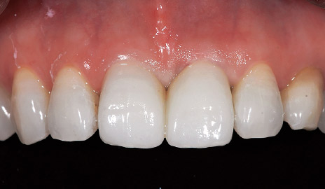 図1-5 UTMLクラウンの透明感は周囲の天然歯に調和しており、所定のクラウンの厚みを確保していれば、支台歯の色調の影響も受けない。