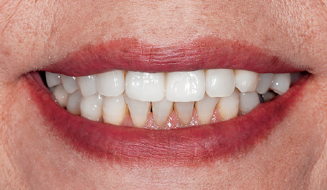 図1-6 カタナジルコニアUTMLを用いれば透明感のある審美性の高い前歯のフルジルコニア修復が可能である。