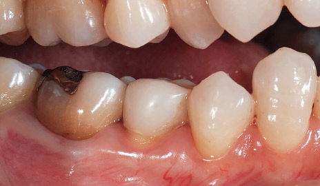 図2-1 初診。下顎右側第二小臼歯の不良補綴装置による審美障害を、フルジルコニアクラウン（カタナジルコニアSTML）で改善することとした。