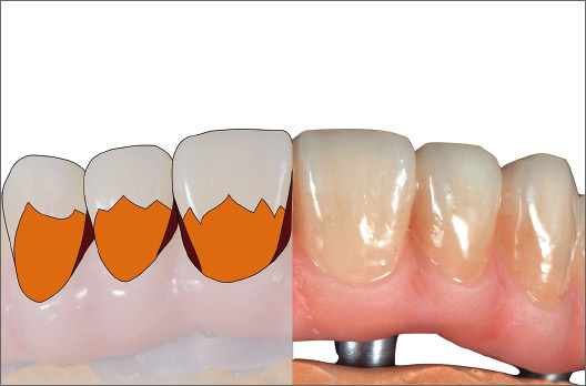 図11 目標シェードにするために歯茎側1/2にA+、隣接面にサービカル１を塗布・仮重合する。