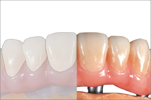図12 決定した色調を持続するためにレジン前装面全体に歯肉部も含めクリアー1をしっかりと塗布する。