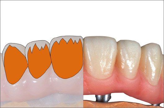 図8 歯茎側2/3にA +を目標シェードより淡く塗布・仮重合する。