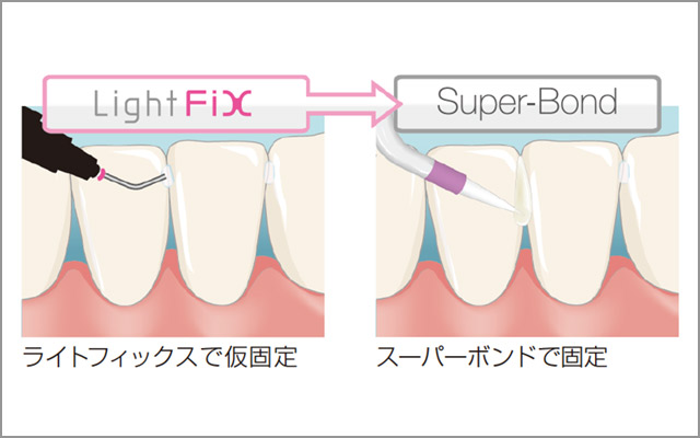 図10 「ライトフィックス」で仮固定した後に「スーパーボンド」で固定する例