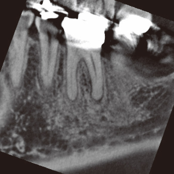 図1c CBCT矢状断でDB根根尖部に病変が確認された。