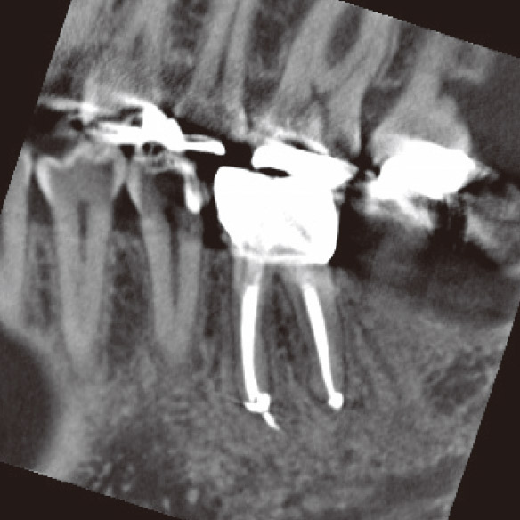 図1h CBCT矢状断（根充後3M）。DB根根尖部に骨が再生していた。