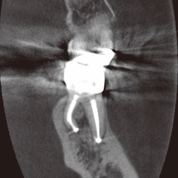 図1i CBCT前頭断（根充後3M）。DL根根尖部の骨も再生していた