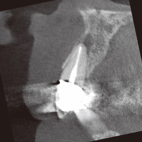 図3b CBCT矢状断。根尖部に口蓋側に広がる病変が確認された。