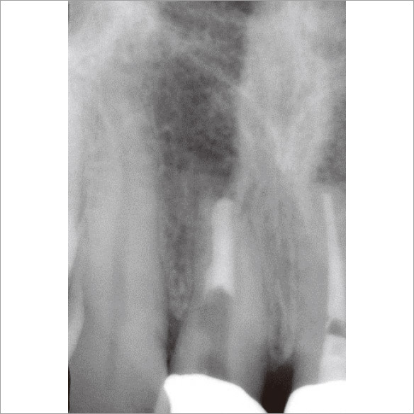 図3e 根管充填後のデンタルX線写真。MTAにて根管充填。