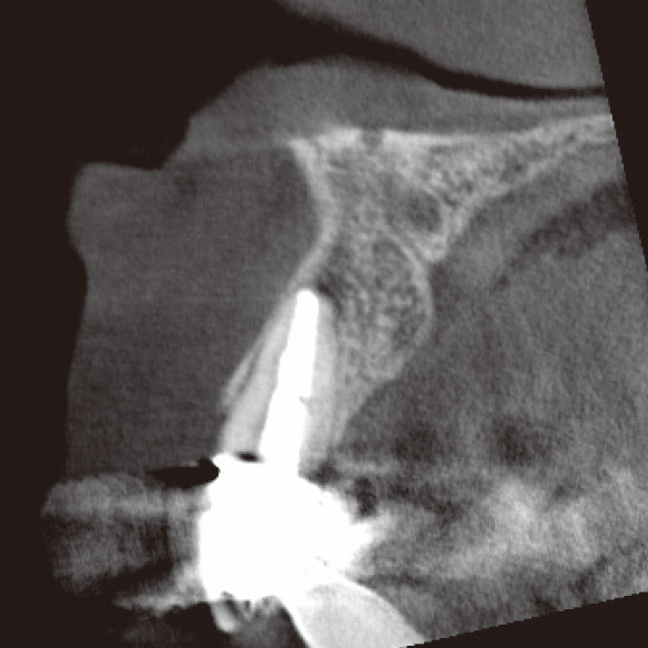 図3f CBCT矢状断（根充後4M）。根尖部に骨が再生してきていた。