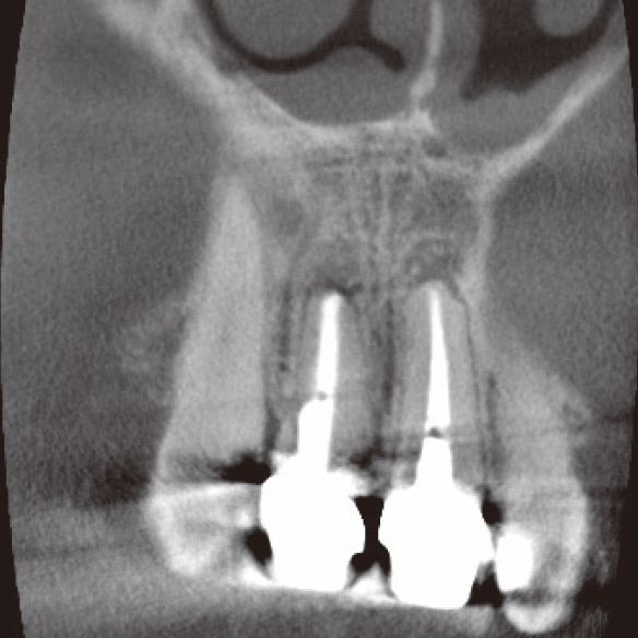 図3g CBCT前頭断（根充後4M）。根尖病変は消え、骨の再生が確認できた。