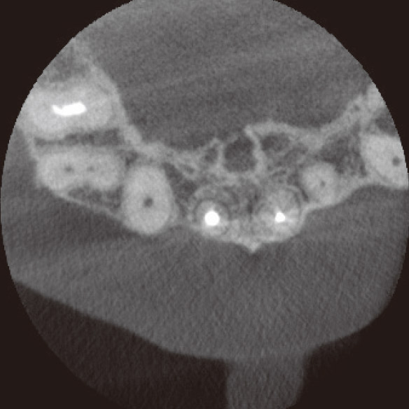 図3h CBCT水平断（根充後4M）においても、骨の再生が確認できた。