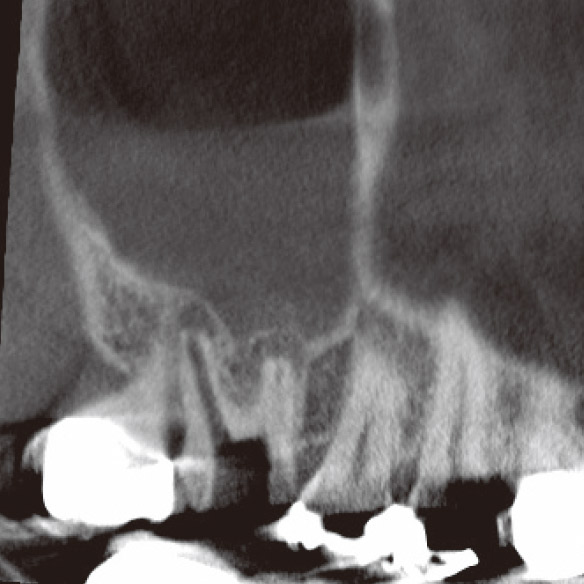 図4b CBCT（矢状断）では頰側根根尖部に病変が確認された。