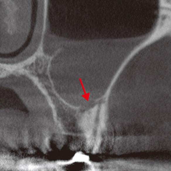 図4c 術中のCBCT（前頭断）。MB2根根尖相当部に骨欠損（→）、上顎洞に粘液の貯留が認められた。