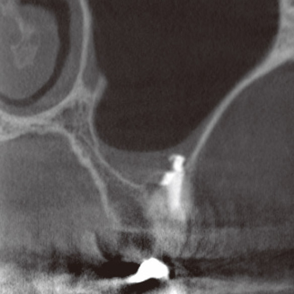 図4e CBCT前頭断（MTA根充直後）。貯留粘液は著しく減少していた。