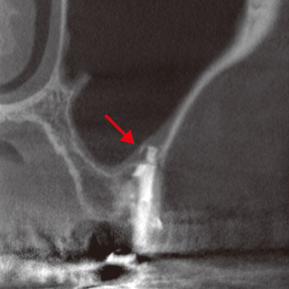 図4f CBCT前頭断（根充後2M）。貯留粘液は消失し、上顎洞底に骨が再生してきていた。