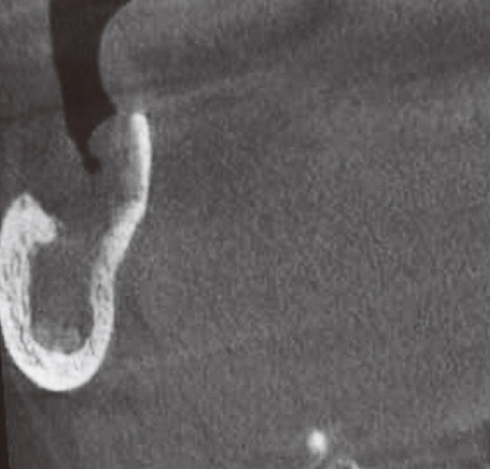症例2-4 遠心方向からのCT画像ではさらに海綿骨の希薄さが確認できる。