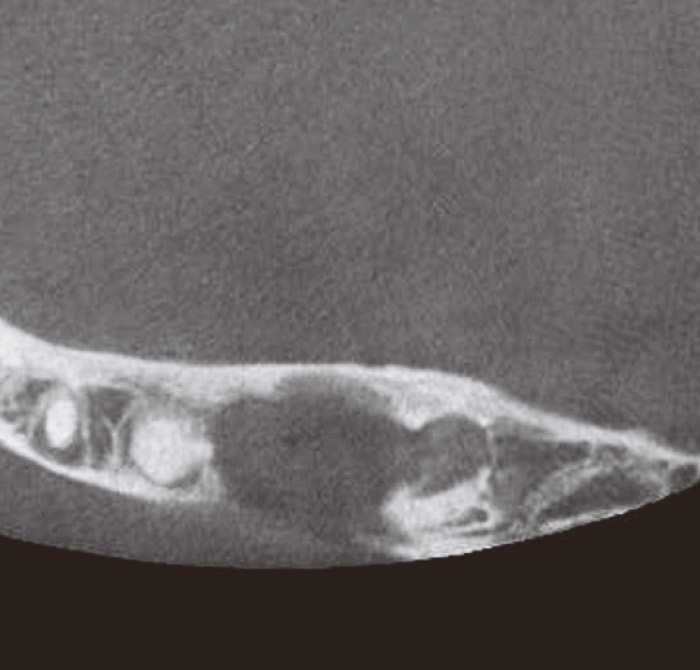 症例2-5 咬合面方向からのCT画像では抜歯窩の骨欠損が確認できる。