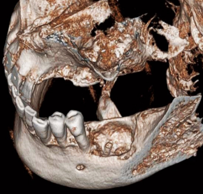 症例2-6 3Dによる立体画像は患者さんに骨吸収量を理解していただくために有効である。