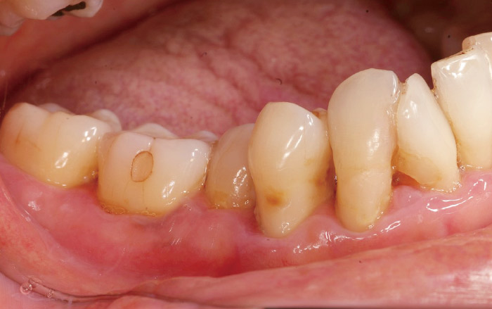 症例1-1 #47は一見問題なさそうにみえるが頰側部から遠心部にかけて10mm以上の歯周ポケットが存在する。