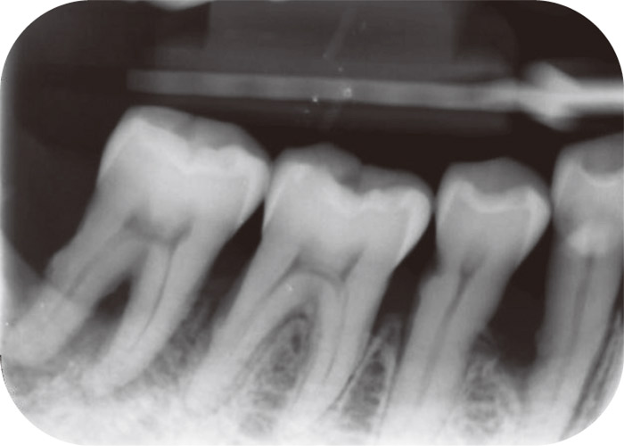 症例1-2 同部位のデンタルX線写真では遠心根の周囲の骨が吸収していると想像できる。