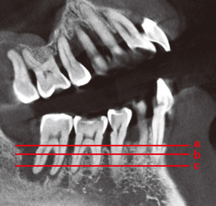 症例1-3 さらにCT撮影を行い赤線方向にスライスして骨吸収の状態を確認する。