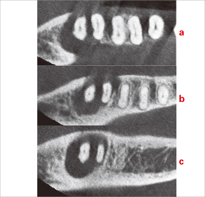 症例1-4 歯頸部は頰側、舌側の皮質骨が吸収しており根尖付近にかけては海綿骨が吸収している。
