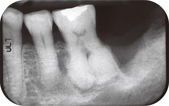 症例2-2 デンタルX線写真で歯根肥大と遠心部の骨欠損が確認できる。